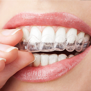 Granger Dentistry | ZOOM Whitening, Veneers and Orthodontics